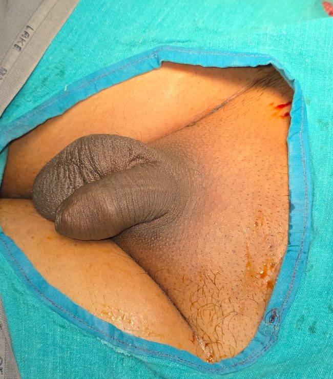 Stapler Circumcision Recovery Photos