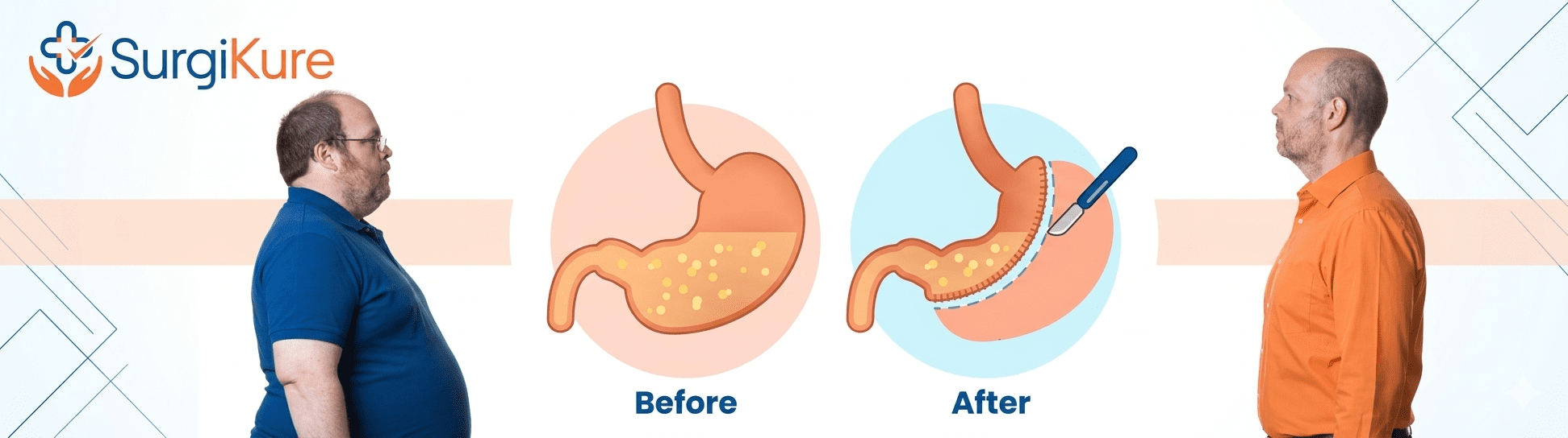 Best Bariatric Surgery in Visakhapatnam