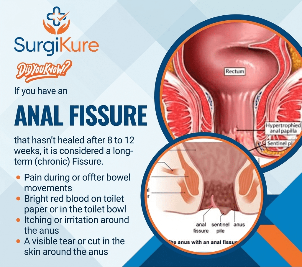 Anal Fissure Treatment