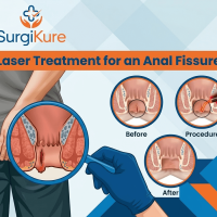 Anal Fissure Treatment
