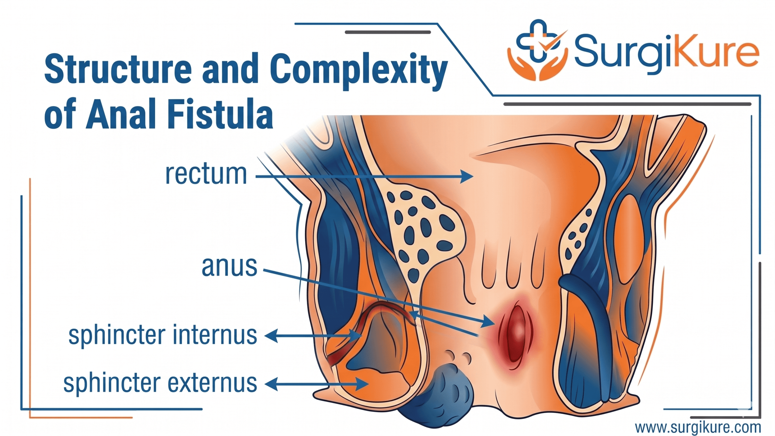 Fistula Treatment in Visakhapatnam