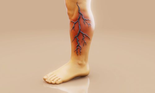Conceptual 3D illustration of a leg with varicose veins