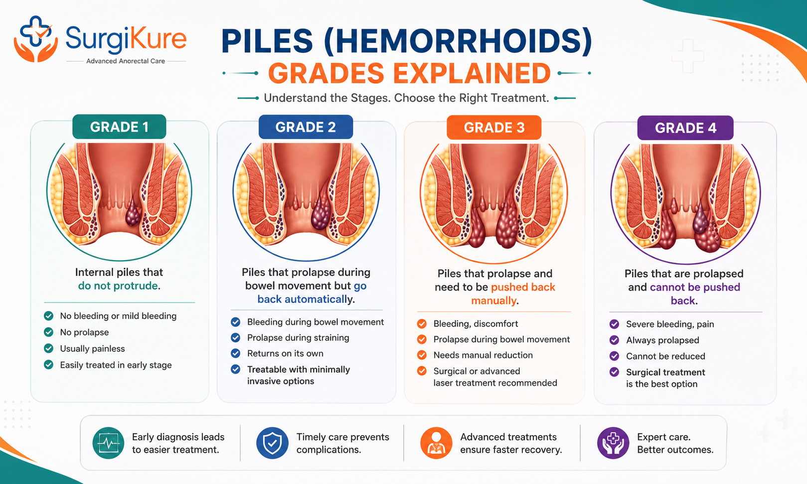 Diagram explaining Grade 1 to Grade 4 piles haemorrhoids